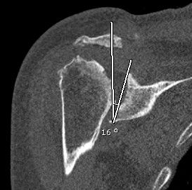 Glenoid Pre Rev TSR Coronal CT